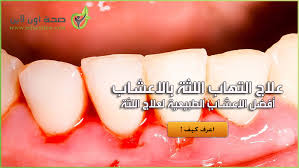 علاج التهاب اللثة بالاعشاب أفضل الاعشاب الطبيعية لعلاج اللثة