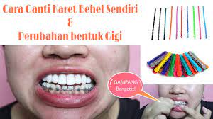 Karet behel tersedia dalam berbagai warna. Cara Ganti Karet Behel Sendiri Di Rumah Tutorial Riana Ramlan Youtube