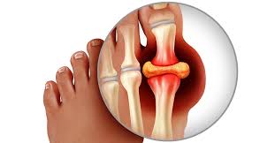 Image result for gout symptoms toe