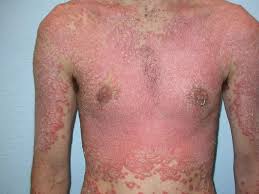 Image result for koebner phenomenon psoriasis