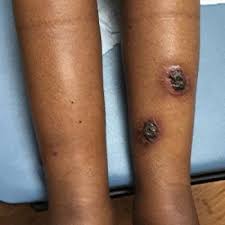 Then, the papule ulcerates to form an eschar or a dark scab over the site.' Rupioid Psoriasis And Psoriatic Arthritis In A Patient With Skin Of Color Mdedge Dermatology