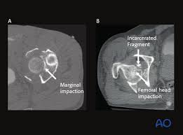We did not find results for: Radiology Of The Intact Acetabulum