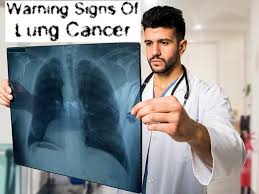 What causes stage iv lung cancer? Warning Signs Of Lung Cancer You Should Never Ignore Boldsky Com