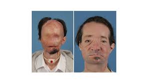 Eighteen months later, after 25 hours of surgery, he received a face transplant at nyu. Dallas Wiens First Full Face Transplant In U S Brigham And Women S Hospital