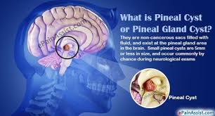 Pin On Pineal Gland Cyst