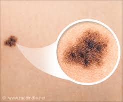 A diagnosis of lung cancer naturally causes some overwhelming emotions, but you don't have to let those emotions get the best of you. New Terahertz Imaging Approach Can Be Useful For Detecting Early Stage Skin Cancer