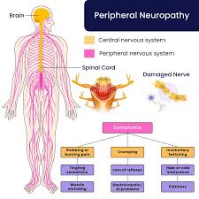 Image result for Peripheral Neuropathy