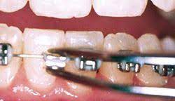 What you can do at home (if. How To Fix Braces At Home Jamesburg Nj