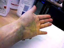 Admin area hoyt sherman custom cut glass careers in advertising noah puckerman glee ten tailed. Different Types Of Fractures Signs And Pictures