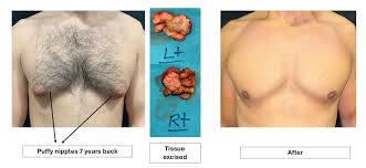 Image result for Gynecomastia
