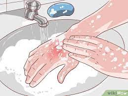 How To Heal A Cigarette Burn: 9 Steps (With Pictures) - Wikihow