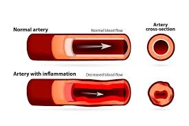 Image result for Vasculitis