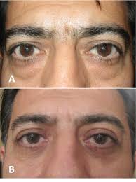 Techniques of Eyebrow Lifting: A Narrative Review