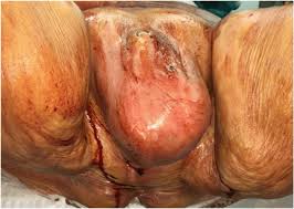 Severe infections, and those at high risk for serious complications. A Contemporary Case Series Of Fournier S Gangrene At A Swiss Tertiary Care Center Can Scoring Systems Accurately Predict Mortality And Morbidity World Journal Of Emergency Surgery Full Text