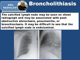 Image result for Broncholithiasis