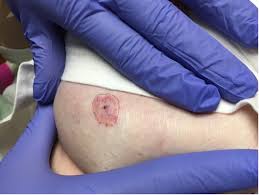 Image result for infected tick bite