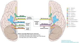 Image result for Neurologic Lesion Localization