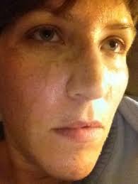 Face-Off: My Jessner Peel Adventure