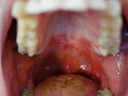 I just ate garlic bread, so i'm won. Red Spots On Roof Of Mouth Causes And Other Symptoms