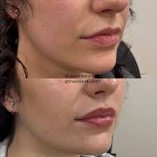 Playing around with more fillers this week & still the same  natural/hydrated look we love 1:1:1 ratio between this patients nose, lips  and chin