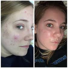 If you can, i think it would be ideal to go to a dermatologist and see what they say. 19 Best U Peachesandcreamtea Images On Pholder Makeup Addiction Progresspics And Reddit Laqueristas
