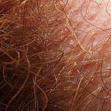 Often time's people just assume white hair is in relation to someone being old. Trichobacteriosis Axillaris Wikipedia