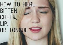 How To Treat And Heal A Bitten Tongue Lip Or Cheek Lip Healing Blister On Lip Blister On Tongue