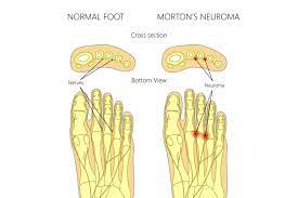 This can cause a sharp, burning pain in the ball of your foot. What Is Morton S Neuroma