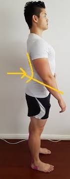 How To Fix An Arched Back Hyperlordosis Posture Direct