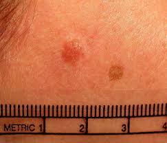 Image result for Spitz Nevus