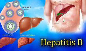 We did not find results for: Waspada Hepatitis B Bisa Menyebabkan Kanker Hati Winnetnews Com
