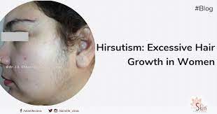 It has to be used for several. Hirsutism Excessive Hair Growth In Women Condition And Treatment