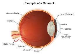 The only way to improve poor vision caused by a cataract is to remove the cataract with surgery. What Is Cataract And How To Treat It Effectively Pittsburgh Eye Associate
