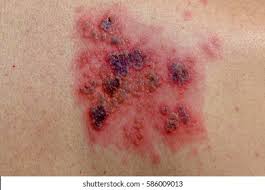 Image result for Varicella zoster on human skin