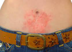 Nickel Allergy How To Detect It How To Protect Against It Allergy Best Buys