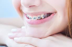 As the conventional method for straightening teeth with braces has always been the traditional way to fix crooked and uneven smiles, little is known of other, faster cosmetic procedures that have the exact same power. 5 Reasons Crooked Teeth Are A Concern Brookside Orthodontics