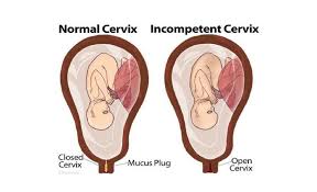 Image result for Friable Cervix