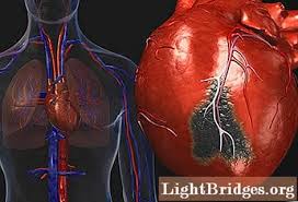 Penyakit jantung koroner adalah penyakit jantung yang paling sering ditemui. Penyakit Jantung Penyebab Serangan Jantung Kesehatan 2021
