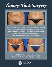 How the aca affects small businesses. 5 Ways To Fade Treat Your Tummy Tuck Scar Edina Plastic Surgery