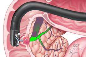 ERCP endoscopic retrograde cholangiopancreatography
