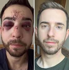 Hey everyone my name is Tom and a little over a year ago in a dr0g induced  stupor I cracked my forehead, broke both of my eye sockets, my nose, my  cheekbones