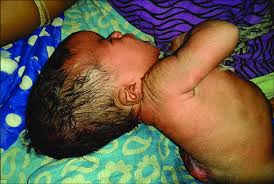 Image result for Hydrocephalus