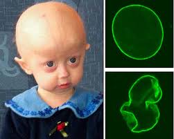 10 Rarest Diseases In The World Rarest Org