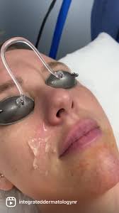 KC Newkirk, MPAS, PA-C is here to help you get your skin glowing for the  summer. Chemical peels can be used effectively for a wide range of skin... 