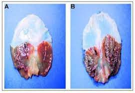 Some of the other causes of pineal gland calcification can include: How To Decalcify Your Pineal Gland And Why It S Really Important
