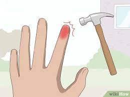 How To Reduce Swollen Fingers: 12 Steps (With Pictures) - Wikihow