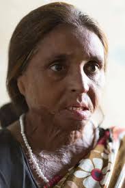 For Rich or for Poor, Till Death Do Her Part: Portraits of Dowry Violence  in India