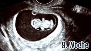 Schwangerschaftswoche erkennbar, allerdings ist es ärzten vor der 12. 9 Ssw Die 9 Schwangerschaftswoche Ultraschall Symptome Tipps Netmoms De