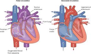 Image result for Delayed Transition from Fetal Circulation