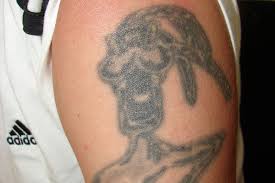 Tattooentfernung Vorher Nachher Fotos